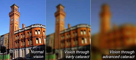 cataract vision